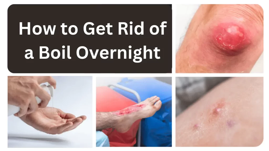 How to Get Rid of a Boil Overnight