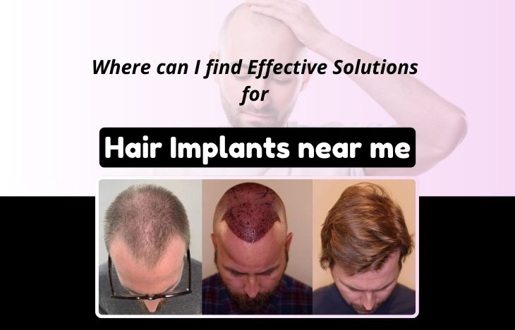 Where-can-I-find-Effective-Solutions-for-Hair-Implants-near-me