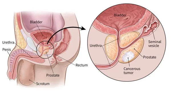 prostate cancer